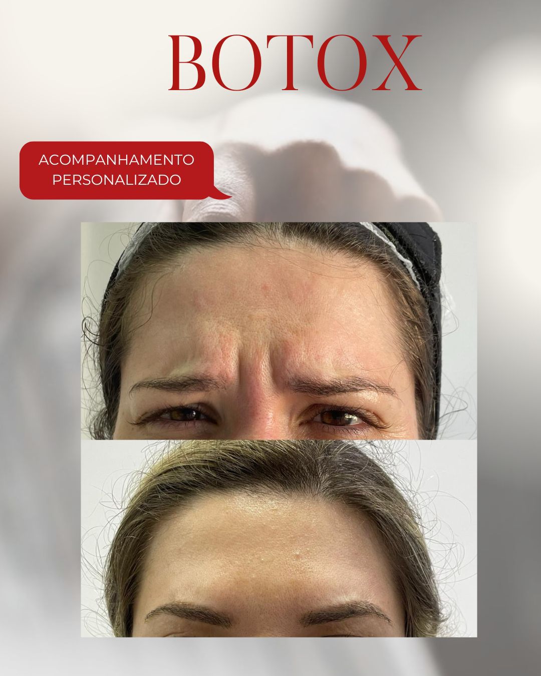 antes e depois Dieisse Kreling