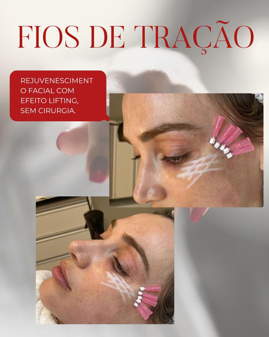Fios de tração